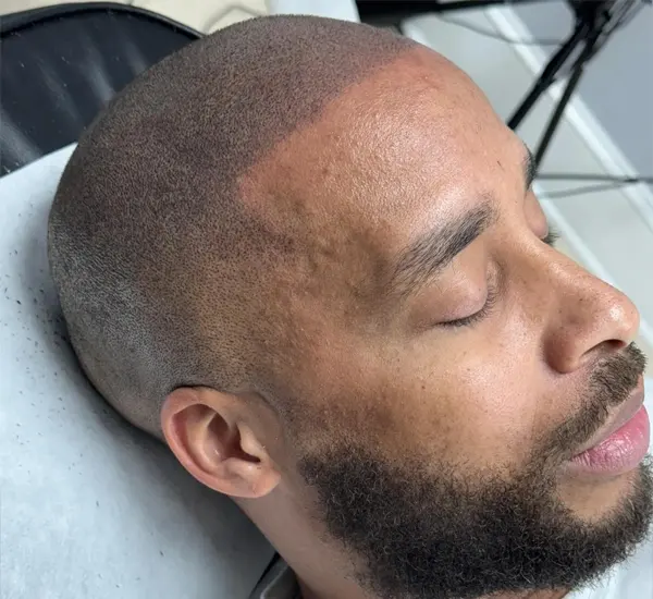 Top-Notch Scalp Micropigmentation in Weddington, NC