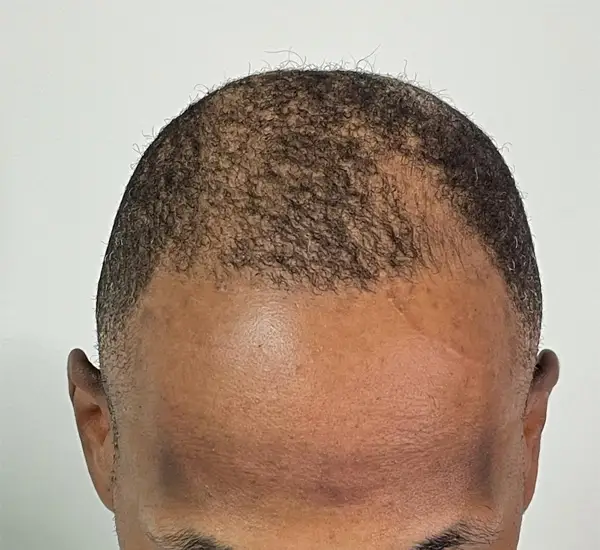 Alopecia Solutions in Weddington, NC