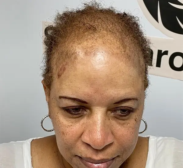 Female Hair Loss Solutions in Mathews, NC