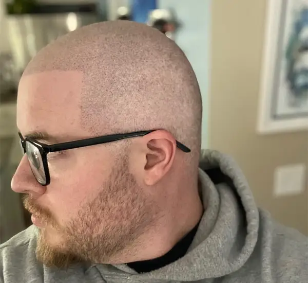 Male Hair Loss Treatment in Charlotte, NC